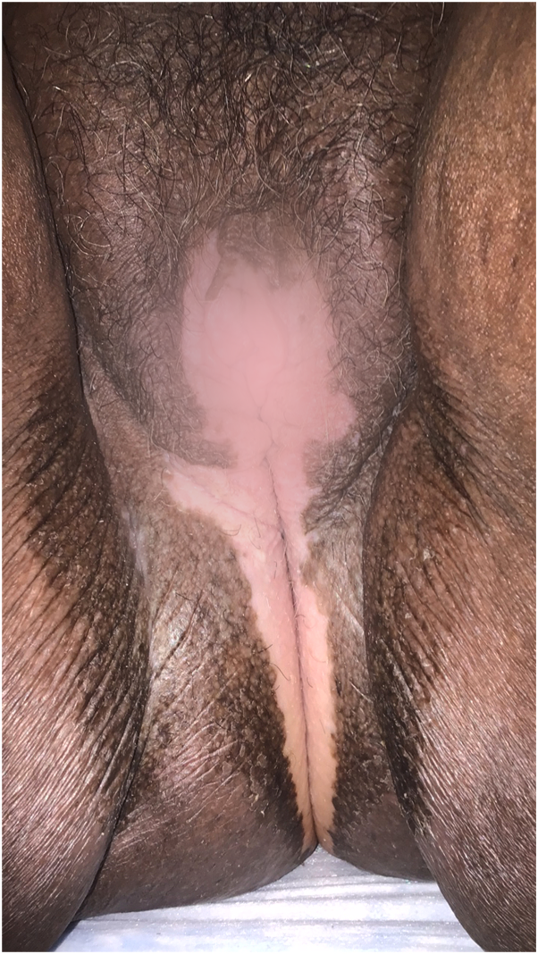 Clinical photograph of darker vulvar skin, with the central area blurred.