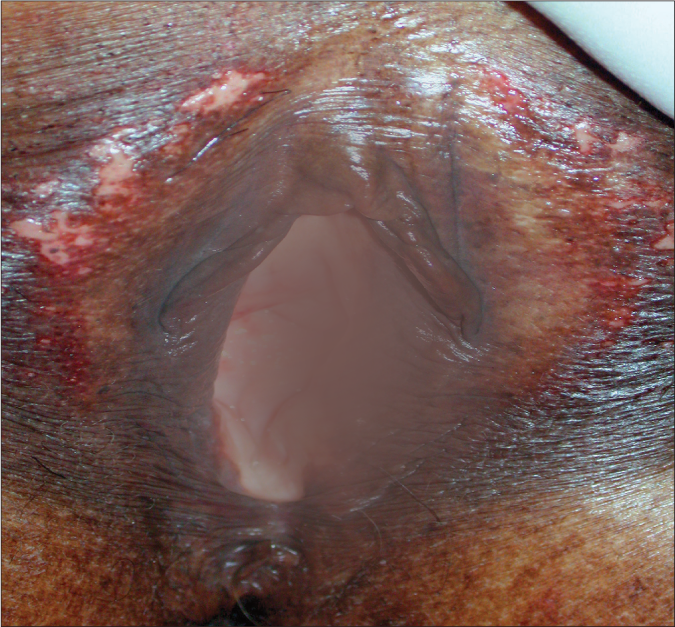 Clinical photograph of darker vulvar skin, with the central area blurred.
